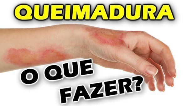 Pele com queimadura de sol Pomada para queimadura