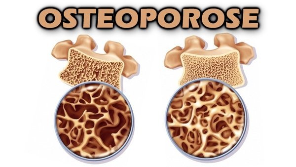 Quais as causas da osteoporose?