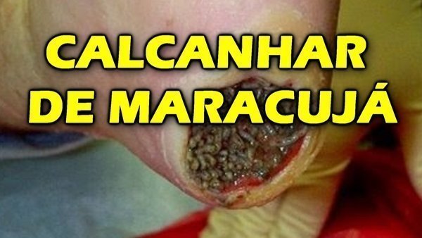 Calcanhar de maracujá tem cura?