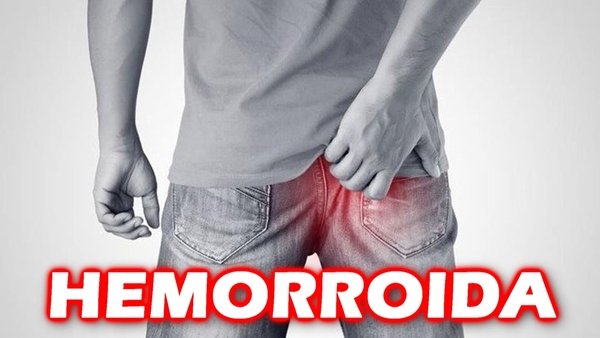 Hemorroida, causas e sintomas