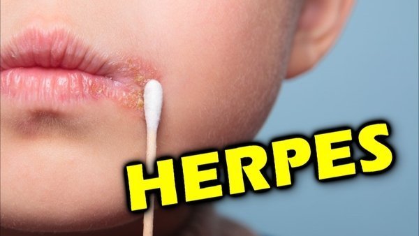 O que é Herpes? Qual pomada usar para Herpes?