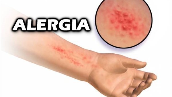 Alergia na pele, como tratar?