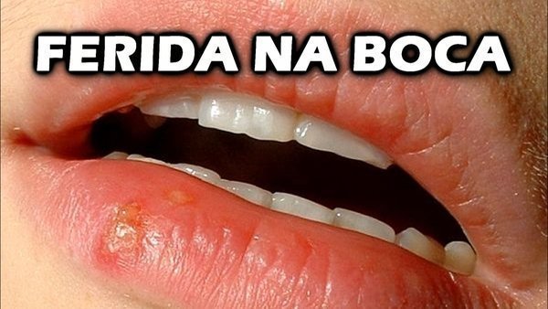 Qual o tratamento para ferida nos lábios?