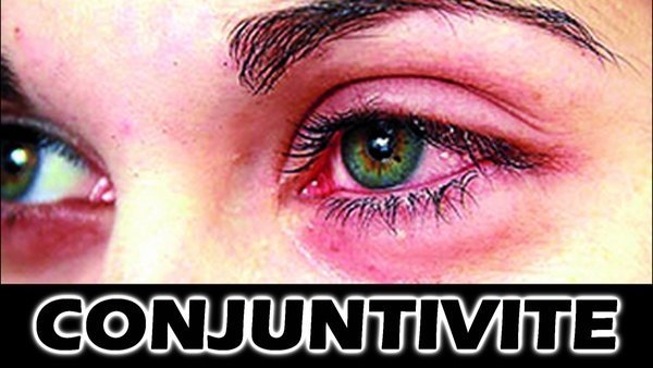 Quais os principais sintomas de conjuntivite?