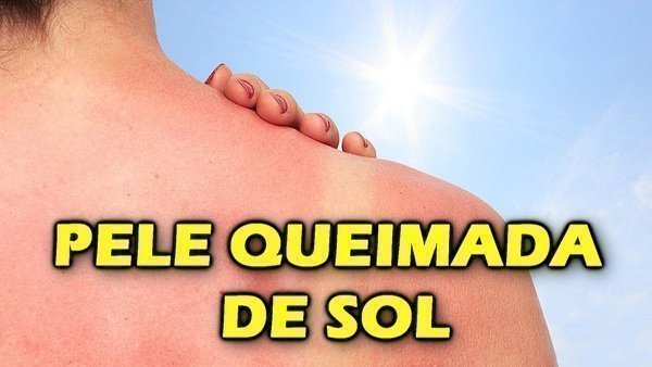 Pele queimada de sol, como tratar?