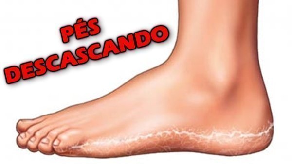 Dedo do pé descascando, o que fazer?
