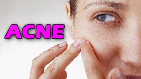 O que causa acne? Como tratar a acne no rosto?