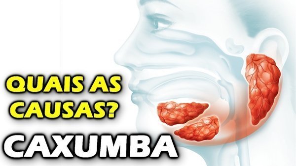 O que é caxumba e quais os sintomas da caxumba?