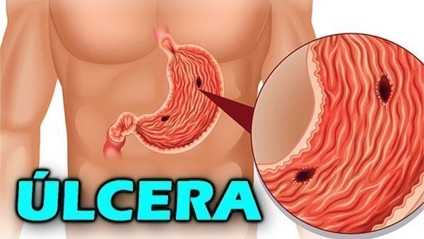 O que é úlcera gástrica?