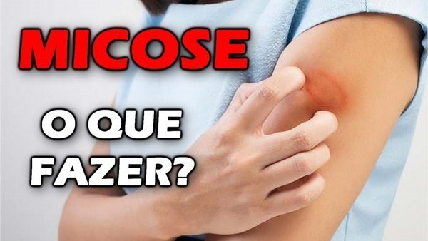 Quais os sintomas de micose?
