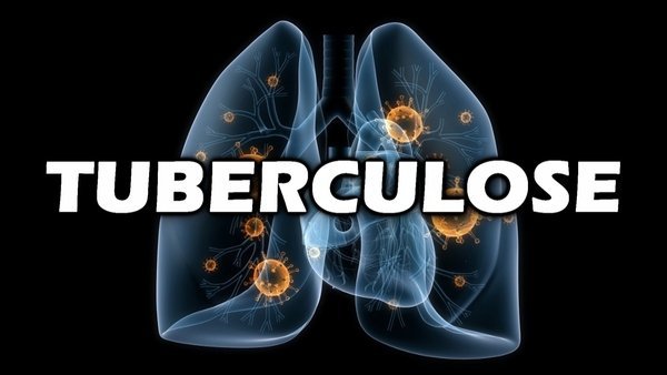 O que é tuberculose e quais os sintomas de tuberculose?