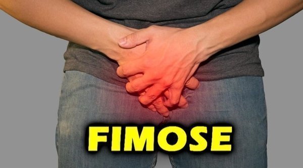 Pomada para fimose
