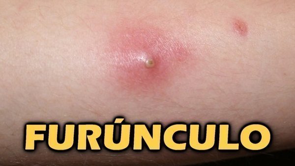 O que é furúnculo? Quais os tipos de furúnculo?