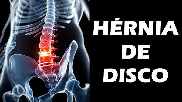O que é hérnia de disco?