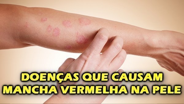Doenças que causam manchas vermelhas na pele