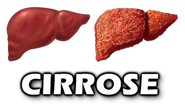 Cirrose hepática, cirrose sintomas!