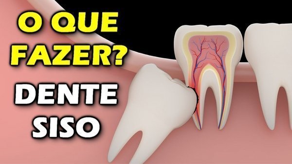 Dente siso nascendo causa dor!