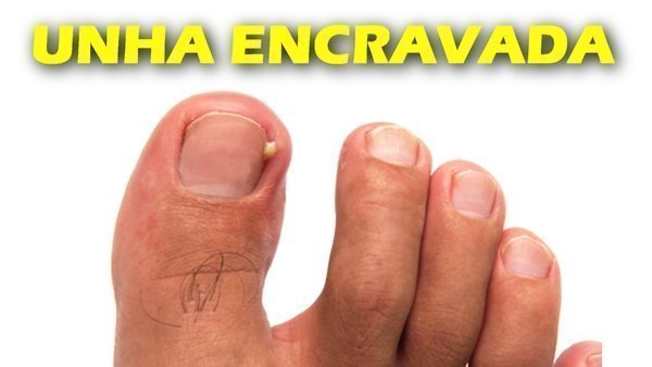 Unha encravada com pus
