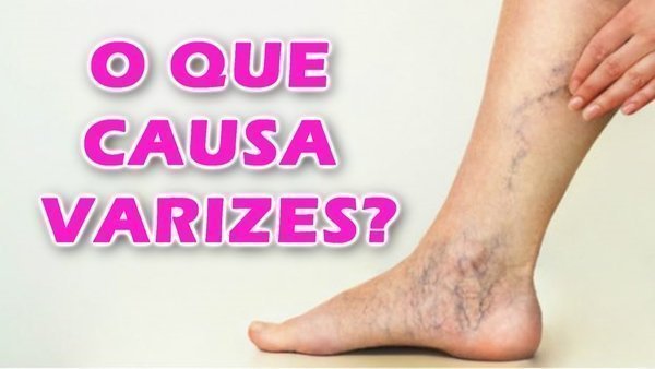 Como acabar com as varizes?