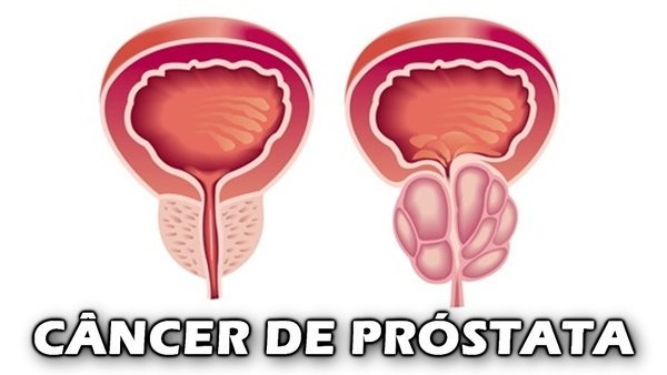 Exame de próstata, qual a importância?