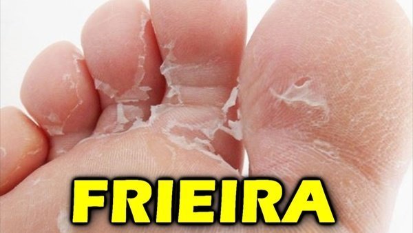 Remédio para frieira ou pomada para frieira!