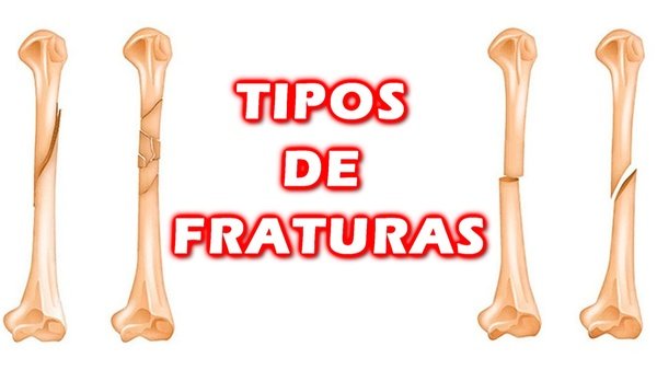 Fratura exposta, o que é?