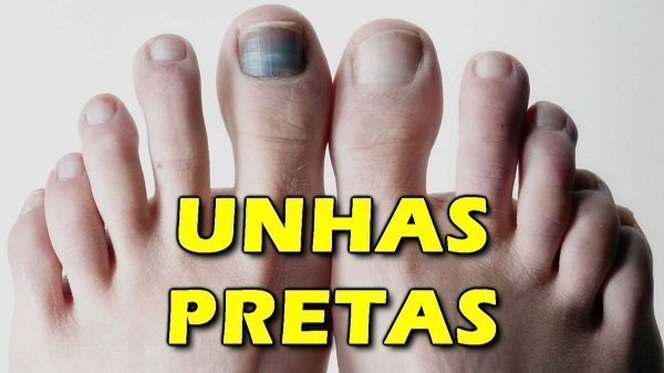 Unha preta, o que fazer?