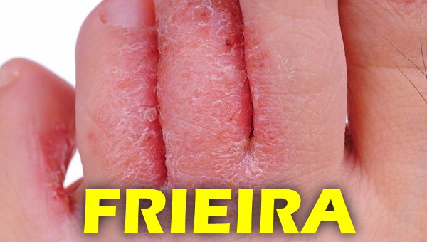 Como acabar com a frieira em 3 dias?
