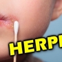 Herpes tem cura? Causas, sintomas e tratamentos!