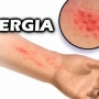 Alergia na pele, o que pode ser? Remédio para alergia na pele