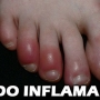 Dedo do pé inflamado, o que fazer para curar dedo inflamado?