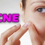 Acne, o que é? Tratamento para acne?