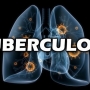 Tuberculose, o que é? Sintomas, causas e tratamento!