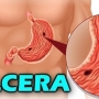 Úlcera, o que é? Causas, sintomas e tratamento!
