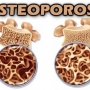 Osteoporose, como evitar essa doença no osso? Qual o tratamento?