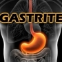 Gastrite, Causas, Sintomas e Tratamento para gastrite nervosa!